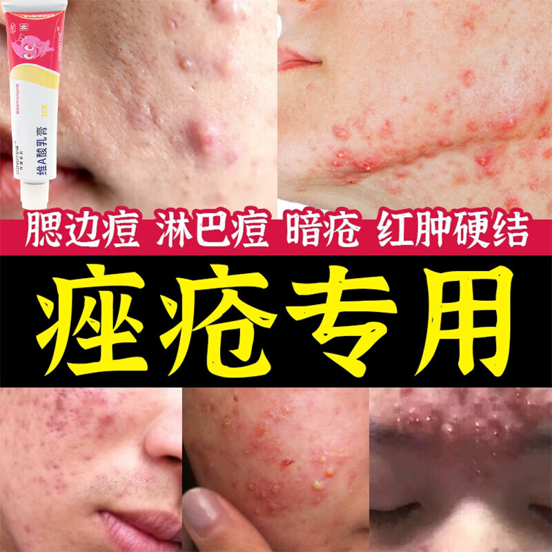 1%*15g 治疗寻常痤疮满脸痘痘脓包红肿痘印 角化异常鸡皮肤鱼鳞病蛇