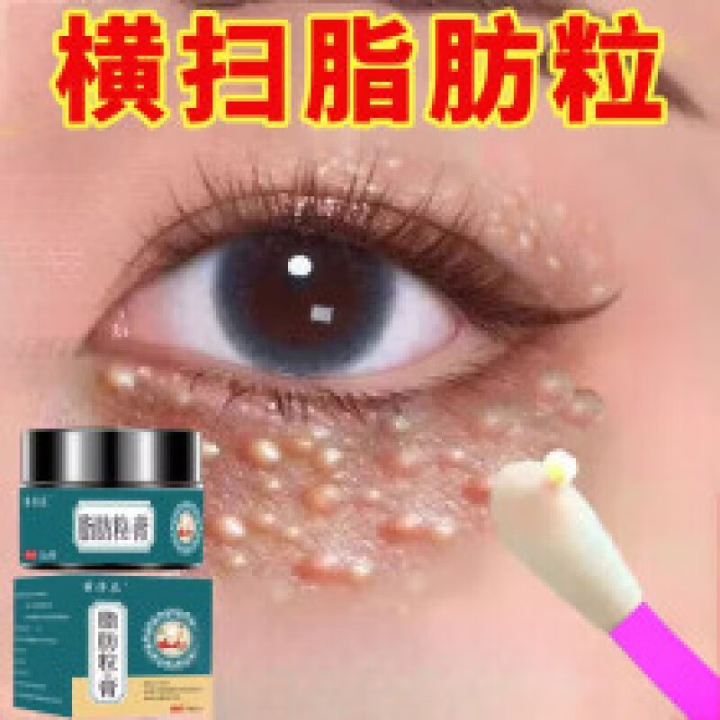 去除i脂肪粒去除神器眼部专用非药膏眼部汗管瘤眼周油脂粒祛掉粟丘疹