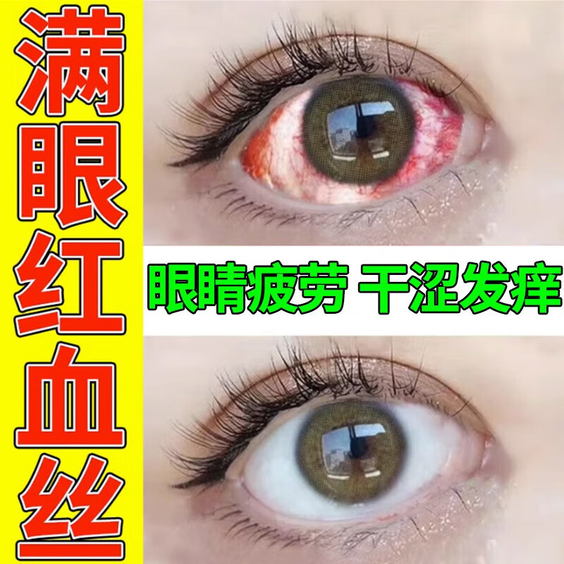 治结膜炎眼药水眼睛干涩发痒异物感眼睛红血丝怕光流眼泪眼红眼疼眼酸