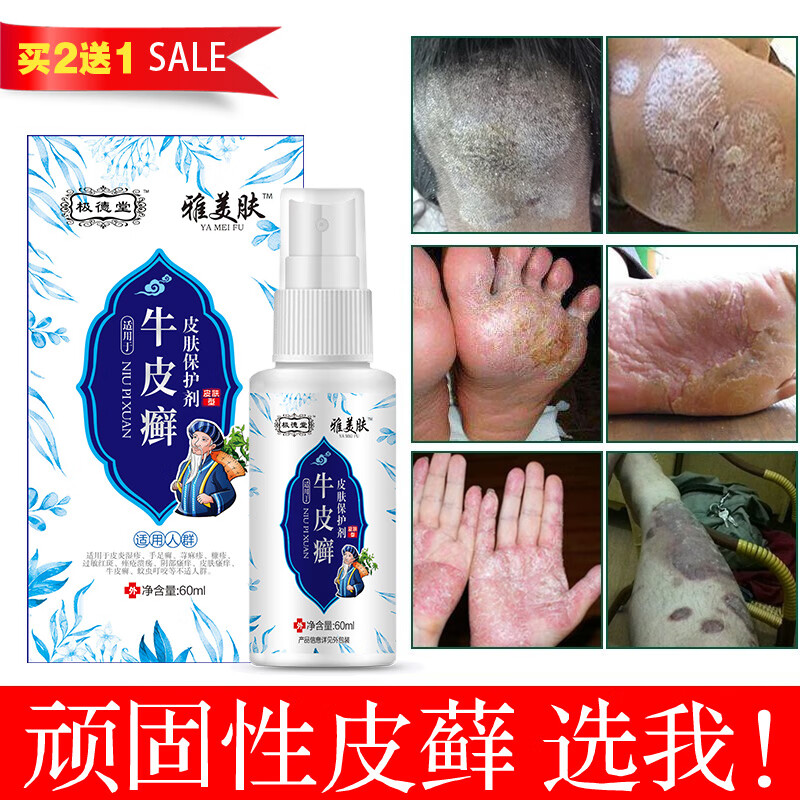 手足藓痒清皮炎湿疹牛皮癣专用苗药顽固牛皮癣银屑i病皮肤癣喷剂体癣药水股癣痒净花斑癣真菌感染疥疮专用膏 癣王喷剂+疥疮膏一支