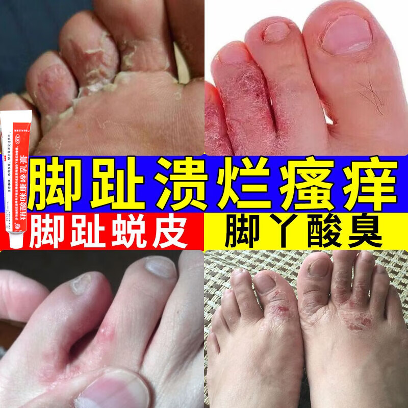 脚趾溃烂脚气脚臭专用药杀菌抗真菌感染消炎治脚气足癣 硝酸咪康唑