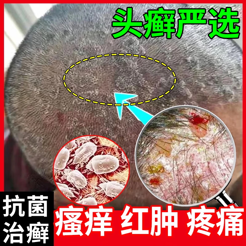 治疗头皮痒脂溢性皮炎特痒效药专用药头皮癣头癣药银屑头皮屑头上长红