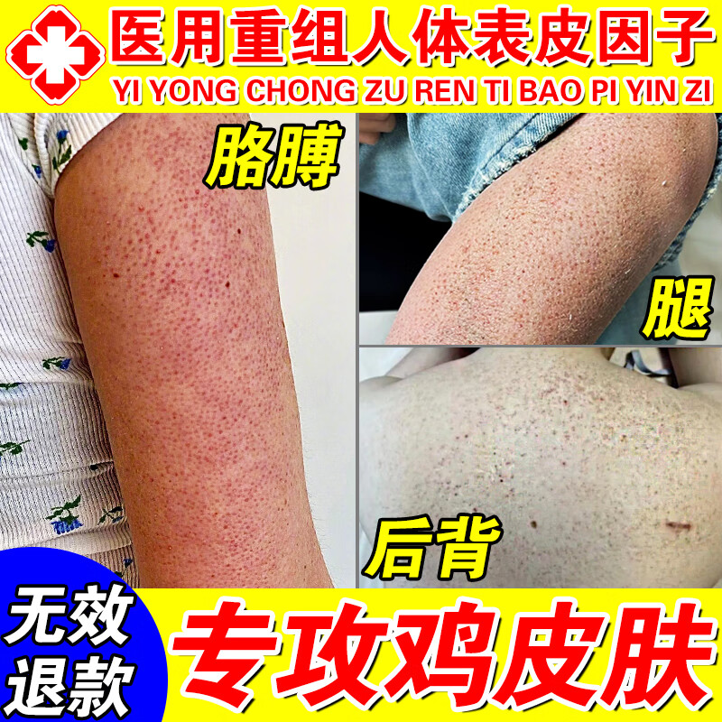 鸡皮肤疙瘩毛囊角化症专用薬药手臂去鸡皮肤毛囊角质疙瘩大腿 手 买二