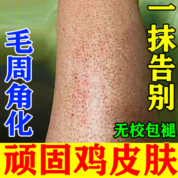 毛周角化症去除手臂脸部腿部去鸡皮肤疙瘩毛囊角化角质磨砂膏神器