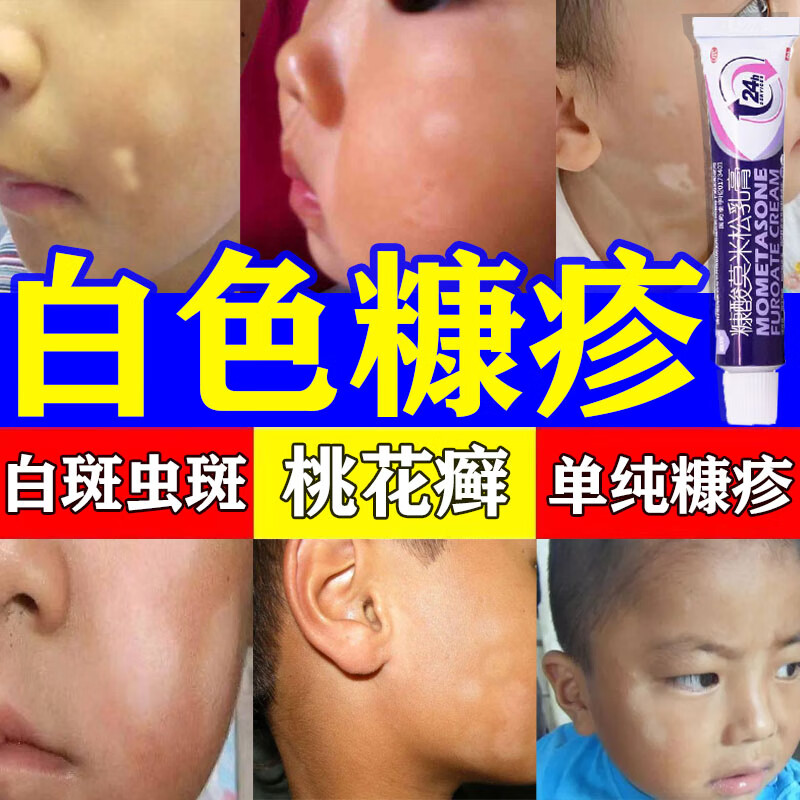 白色糠疹儿童成人用药膏】 儿童脸上白斑脸上小圆形白斑白癣桃花癣虫