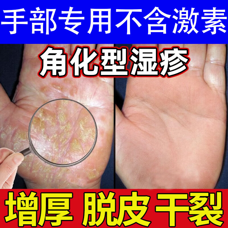 药店同售手部角化型湿疹可搭药膏手足癣真菌感染手指手掌皮肤瘙痒干燥