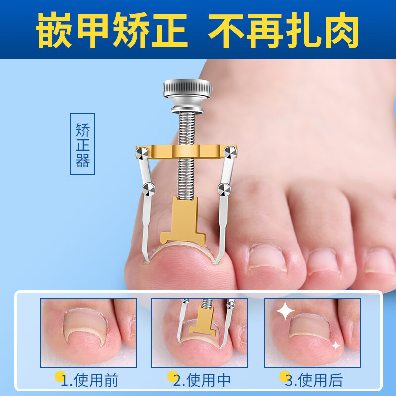 甲沟炎嵌甲器沟脚指甲内嵌脚趾甲勾盖长肉里指甲矫正适用 甲沟炎无痛
