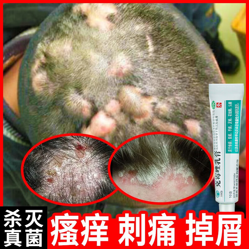 治头癣特痒药头皮癣专科用药头皮痒脂溢性皮炎头皮屑多头皮痒头皮屑药