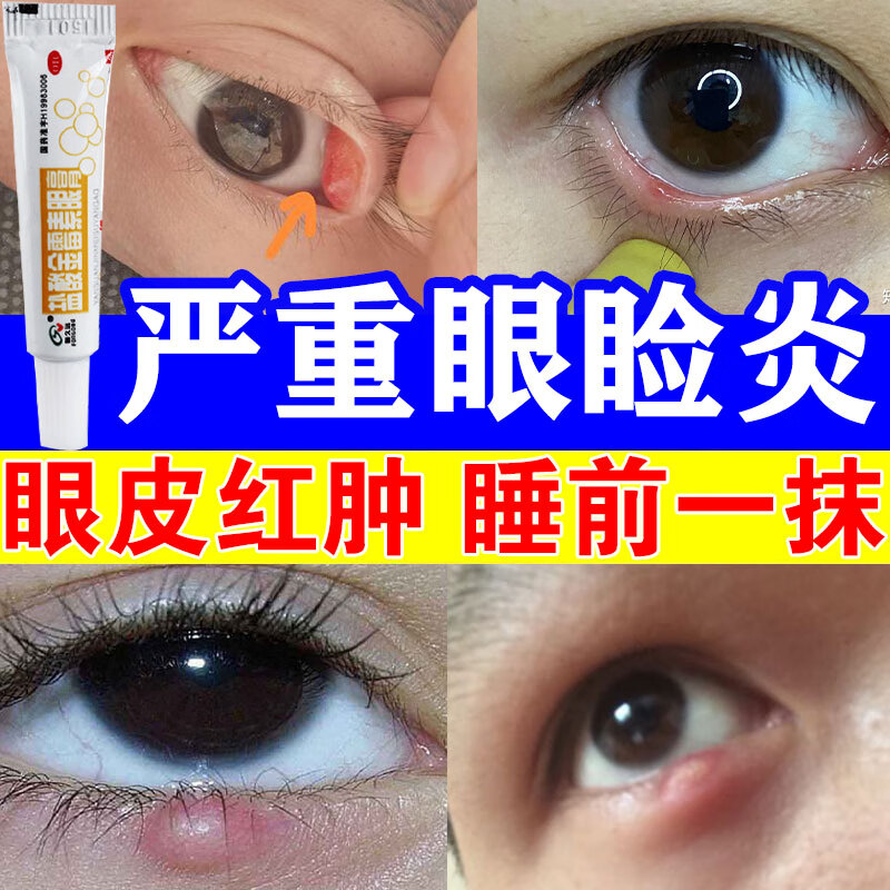 眼睑炎麦粒肿药膏】治疗细菌性结膜炎眼睑炎麦粒肿沙眼眼皮长红疙瘩