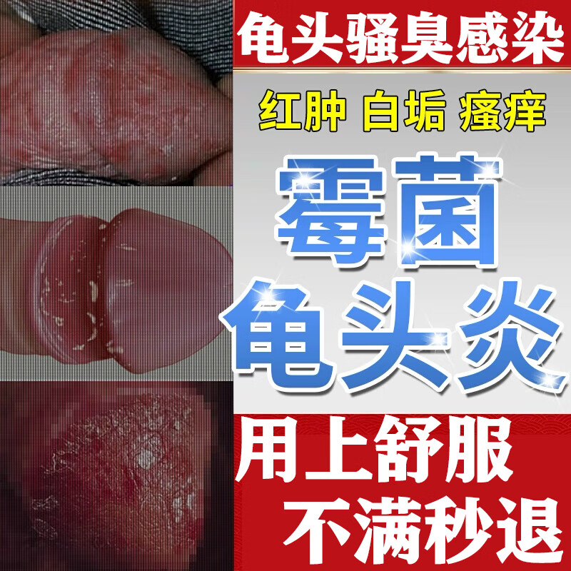 修正医用龟头炎包皮炎专用男士洁阴护理液私处洗液私处