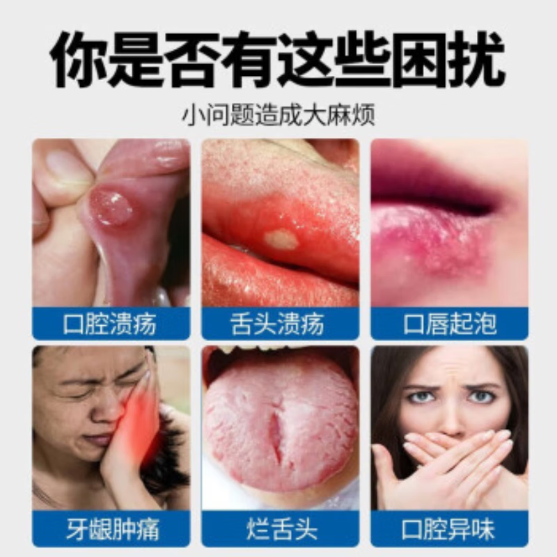 岩井晟弘制药日本口腔溃疡特专用的药喷剂凝胶嘴巴反复溃疡上火起泡口舌生疮 特价单盒装【特效喷剂】