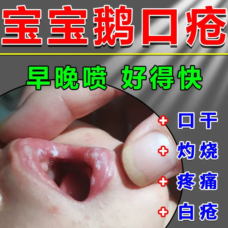 婴儿鹅口疮凝胶口腔喷剂婴儿口腔溃疡喷剂宝宝雪口疮白口糊口疮神 单