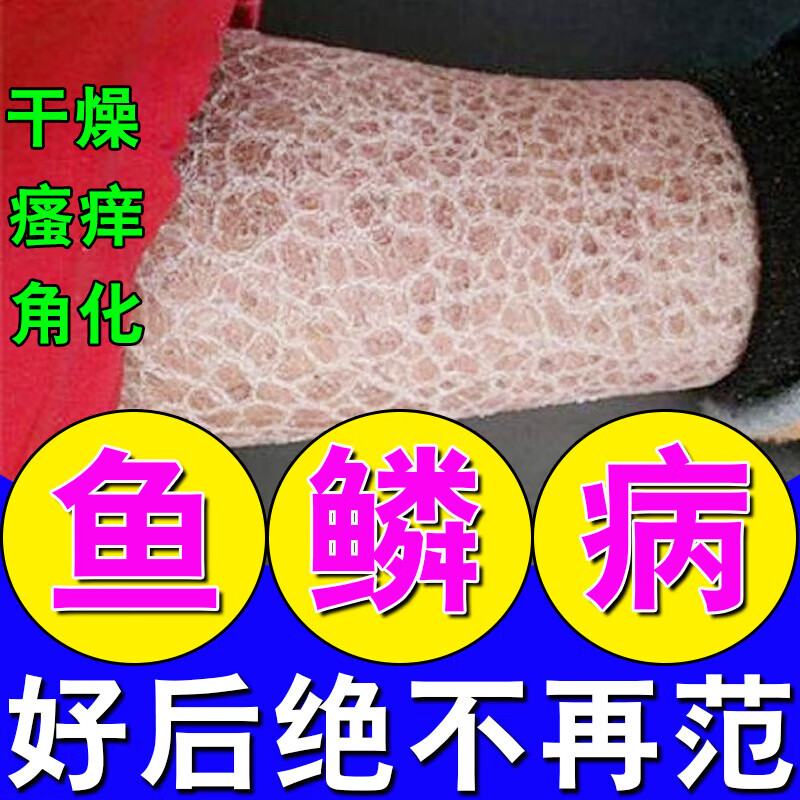 鱼鳞皮肤霜去鱼鳞蛇皮病干燥脱皮鱼鳞病专用特傚非药去鱼鳞蛇皮病 一