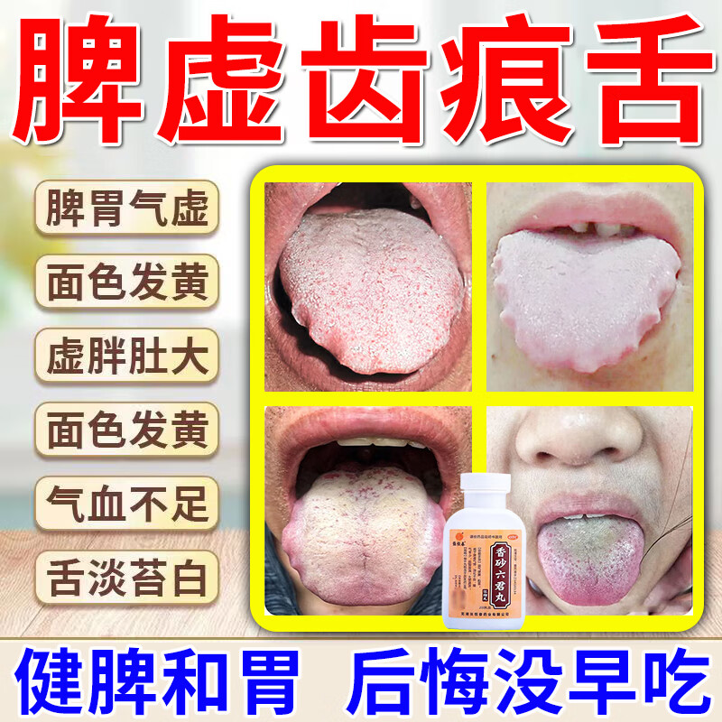齿痕舌吃什么药】舌苔厚白齿痕湿气重脾胃虚弱引起的舌苔发白舌体胖大