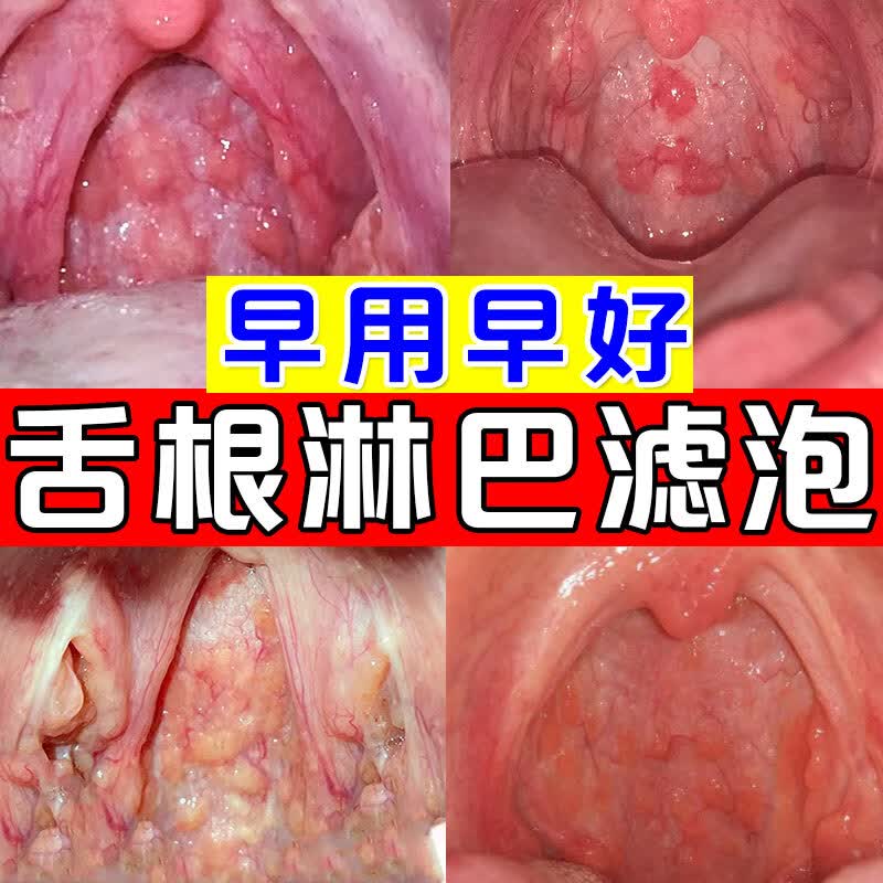 淋巴滤泡增生慢性咽炎咽喉壁充血异物感强喉咙干痒咳嗽有痰咳不出清痰