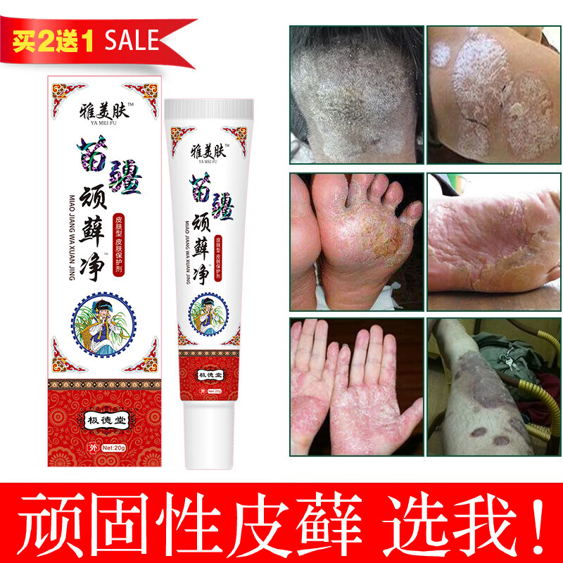 雅美肤牛皮癣专用股癣大腿内侧瘙痒红疹止痒膏苗疆顽藓净手足癣真菌感染 苗疆顽藓净软膏【20g/支】