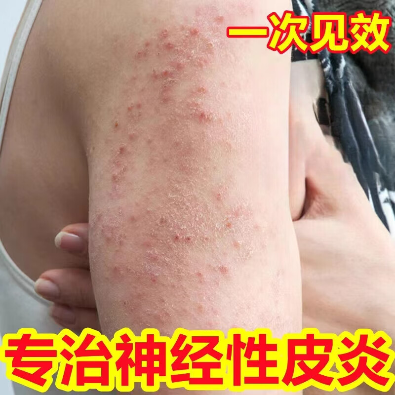 藏药藏灵奇草神经性皮焱湿珍止痒根去日光溢脂性紫外线过敏膏药 一盒装 营自大药房