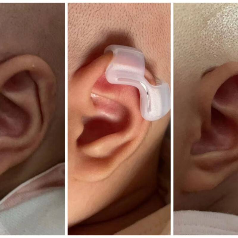 婴儿耳朵耳廓器宝宝婴儿新生儿耳朵纠正器固定塑形招风耳垂耳耳朵器