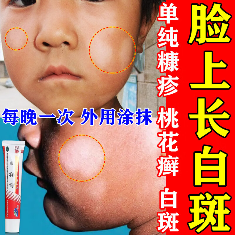 白色糠疹成人儿童用药面部单纯糠疹桃花癣小圆形白斑白癣虫斑脸上肩部