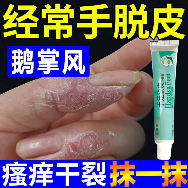 鹅掌风手足脱皮痒脱屑红斑开裂瘙痒湿疹手癣真菌感染皮肤用手指蜕皮膏