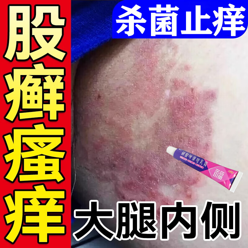 大腿内侧湿疹用什么药图片