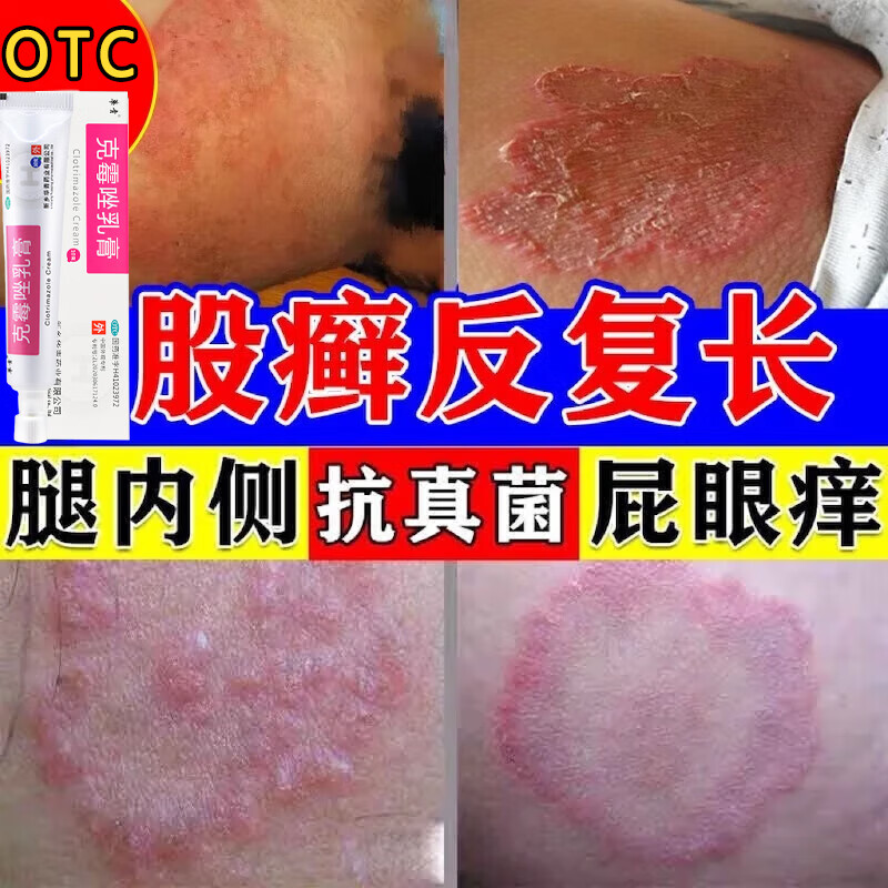 克霉唑软膏股藓大腿内侧真菌感染腹股沟股癣股癣专用药膏私处瘙痒皮肤
