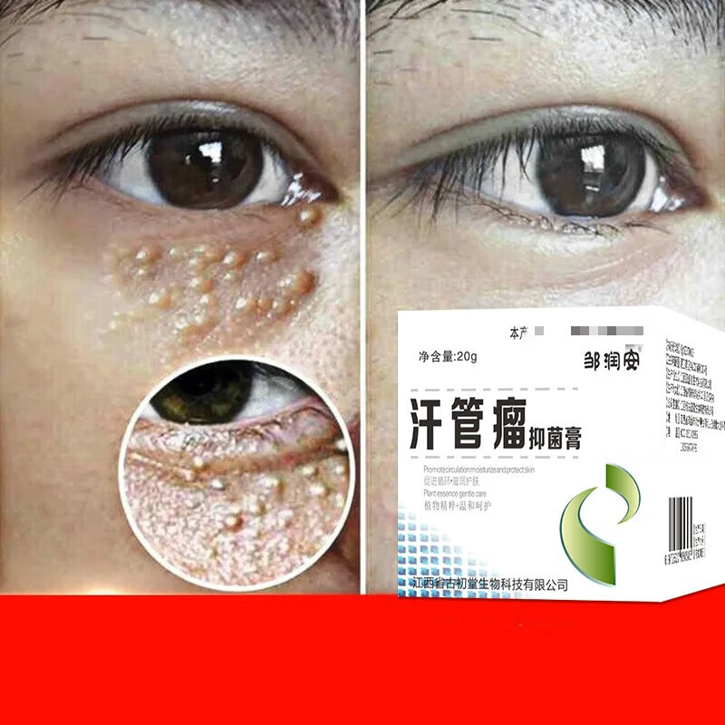 眼部眼霜油脂粒治疗眼周汗管粒 20g