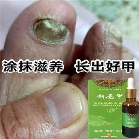 灰指甲特筱效【药房直售】增厚灰甲亮甲脱甲软甲膏 1盒装