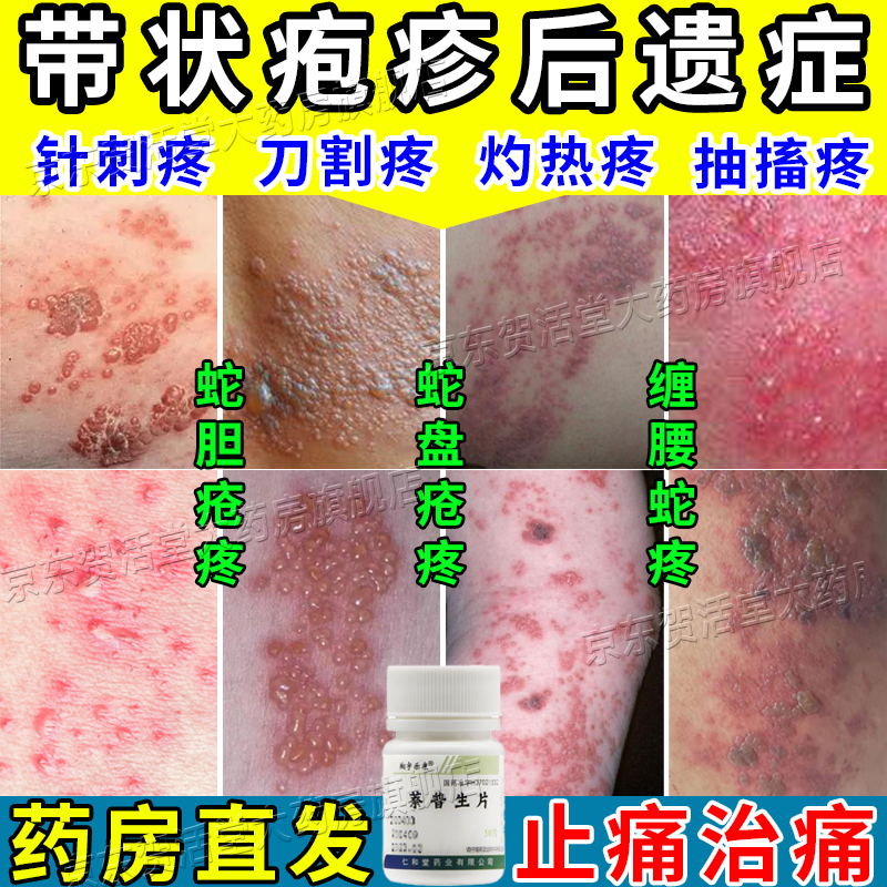 治带状疱疹的止痛药蛇缠腰蛇盘疮蛇胆疮药带状疱疹后遗症引起神经刺痛