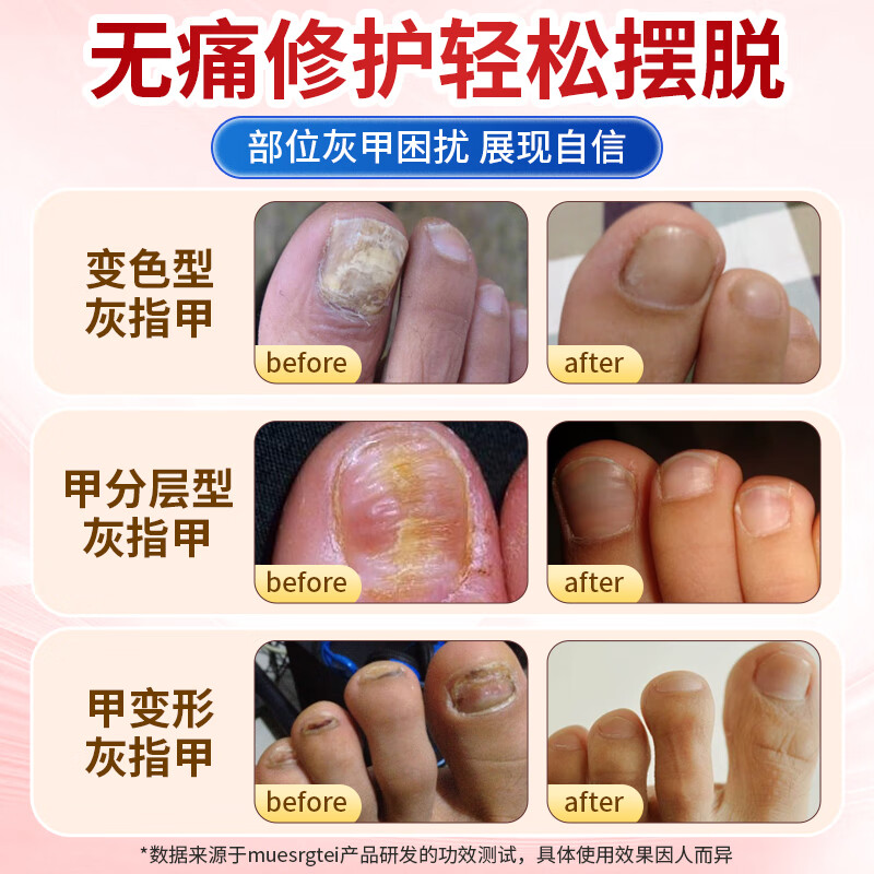 MUESRGTEI德国高端进口灰指甲特殊效去除增厚发黄变空液中草药水灰甲 一盒装【1-2个推荐】