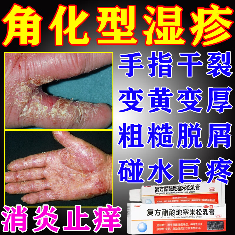 手部角质化湿疹】手指皲裂性湿疹药膏手部脚步脱皮瘙痒干裂止痒去皮炎