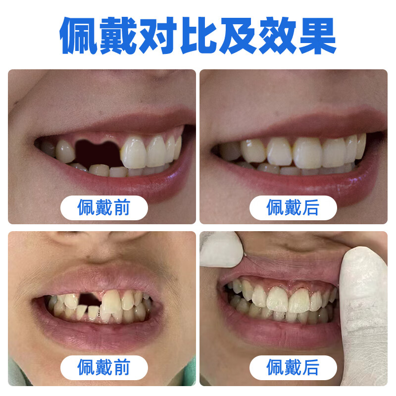 伢益添牙科同款定制隐形义齿门牙假牙定制遮丑隐形假牙假牙齿仿真临时牙 【推荐】超硬塑钢牙【可啃骨头】 缺几颗咨询下单【送取模材料】