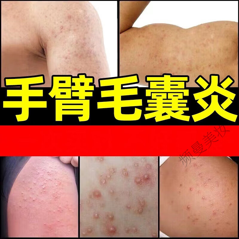 cxq【官方】云南本草冶手臂毛囊炎长痘痘胳膊上的小疙瘩专用膏鸡皮肤