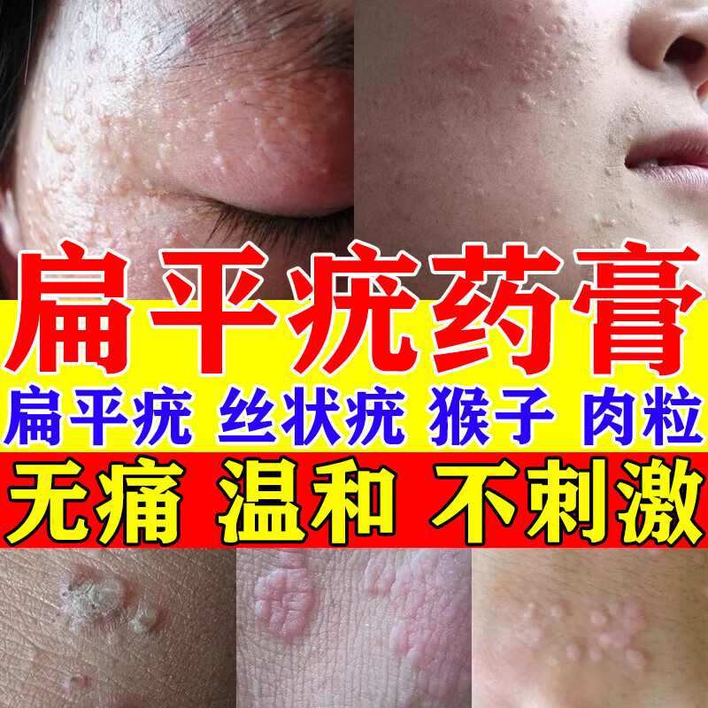 五妙水杨酸软膏水仙国药准字号扁平疣专用药膏祛疣瘊子扁平疣去脖子上