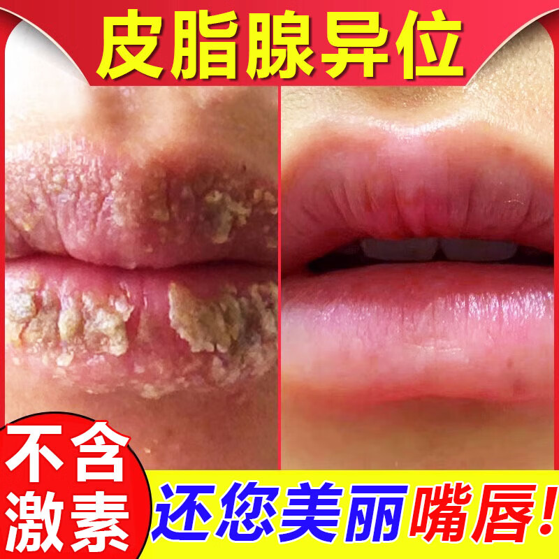 皮脂腺异位症可搭去除嘴唇白点增生嘴唇迷你疱痒疹旺盛拔祛毒口角 单