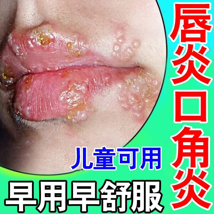 唇炎专用的药慢性唇炎嘴唇干裂口角炎儿童烂嘴角润唇膏溃疡疱疹开裂