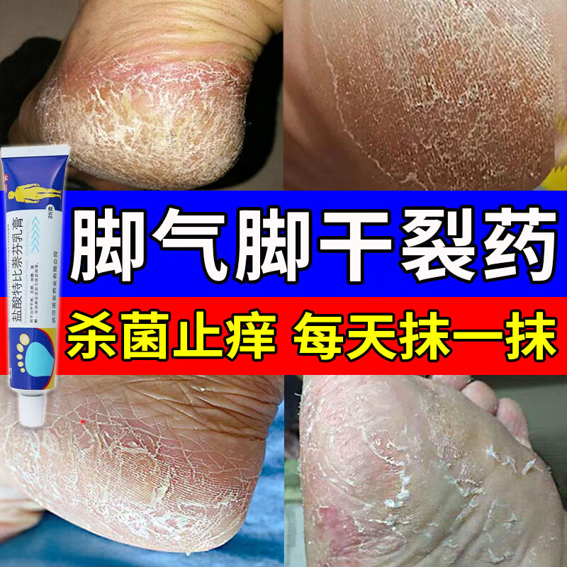 角质化手足癣脚气药止痒脱皮烂脚丫真菌感染止痒 角化型脚气脚后跟