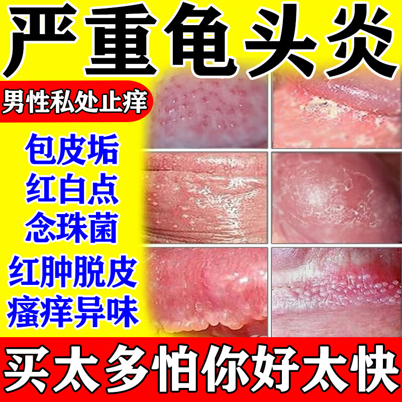 龟头炎包皮炎症专用药治疗念珠菌性龟头炎的药 软膏男性私处龟头炎