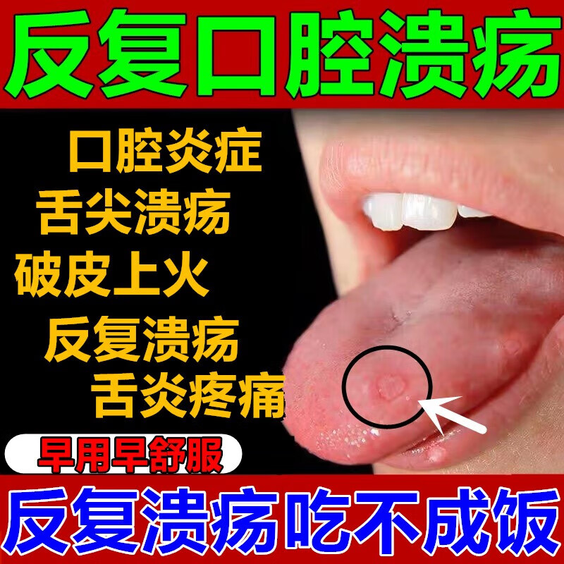 甲硝唑口腔粘贴片口舌生疮 含片治口腔溃疡烂嘴巴上火舌头起泡口腔