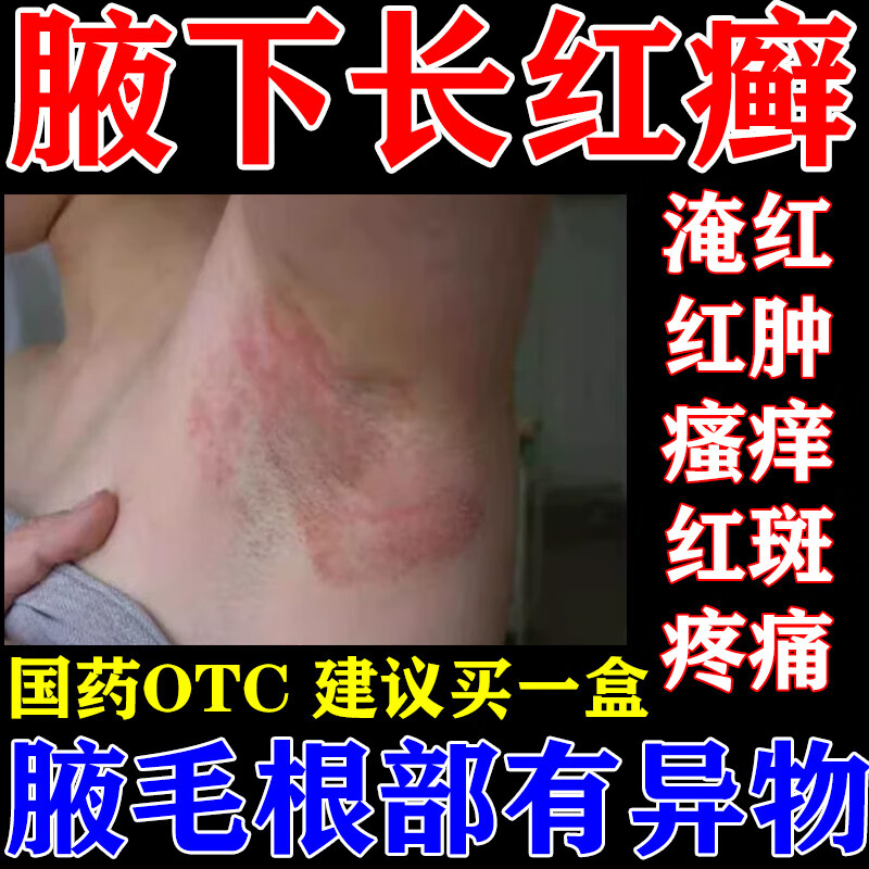 硝酸咪康唑乳膏腋毛癣特专用药膏腋下痒胳肢窝红肿抑菌止痒膏腋下瘙痒