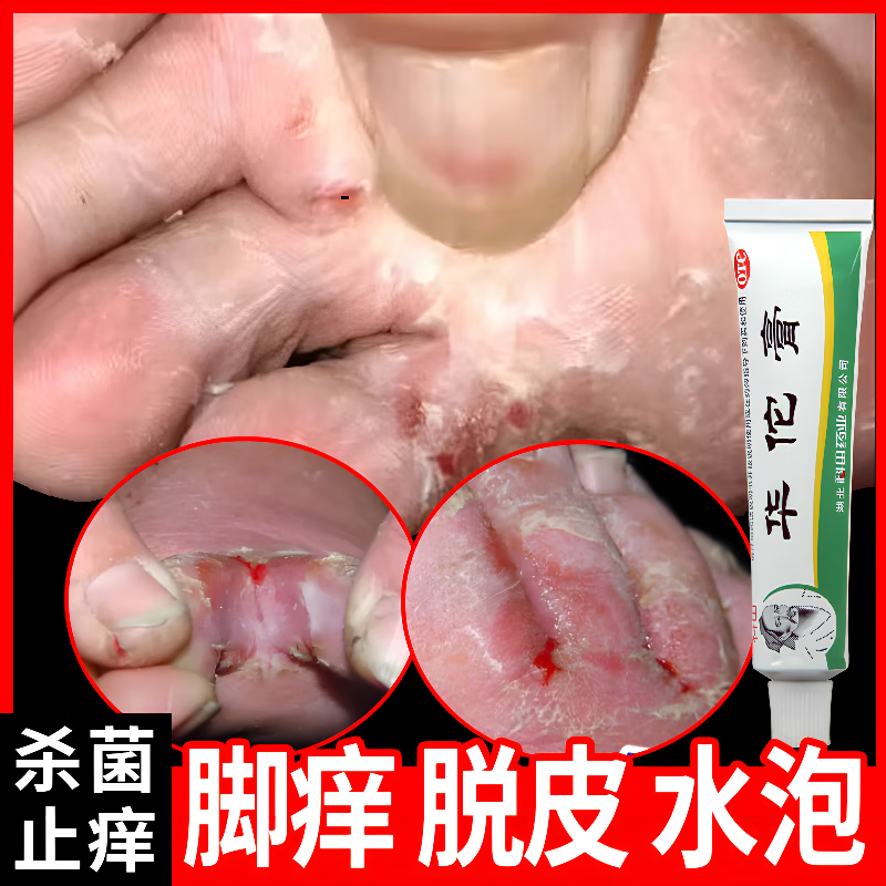 脚气膏止痒脱皮烂脚丫脚气根 治真菌感染皮肤用药脚趾缝痒溃烂脚气