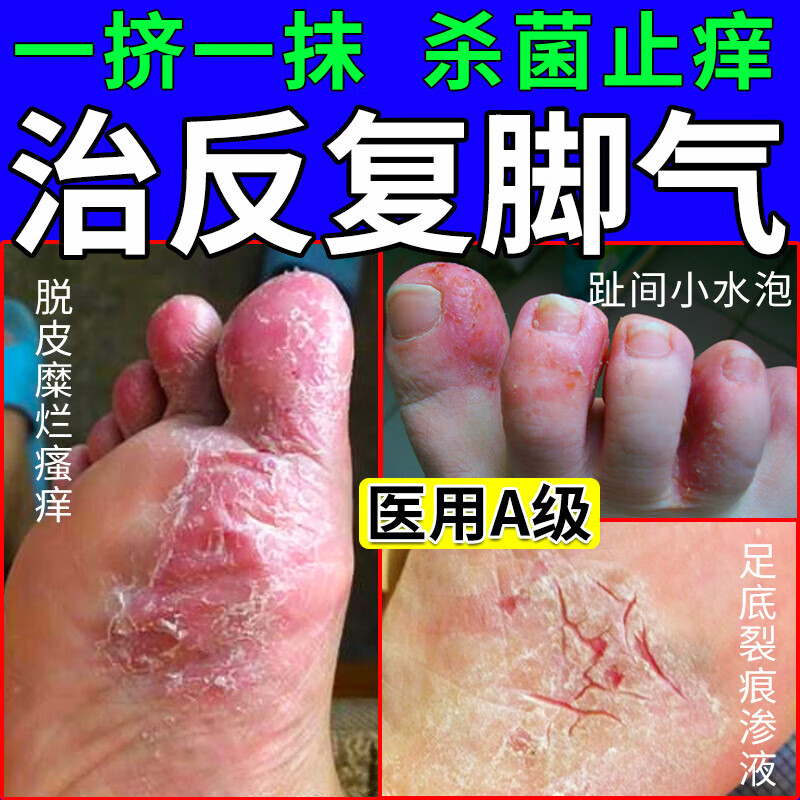 硝酸咪康唑乳膏  脚气药止痒脱皮烂脚丫真菌感染止痒脚臭水泡糜烂香港