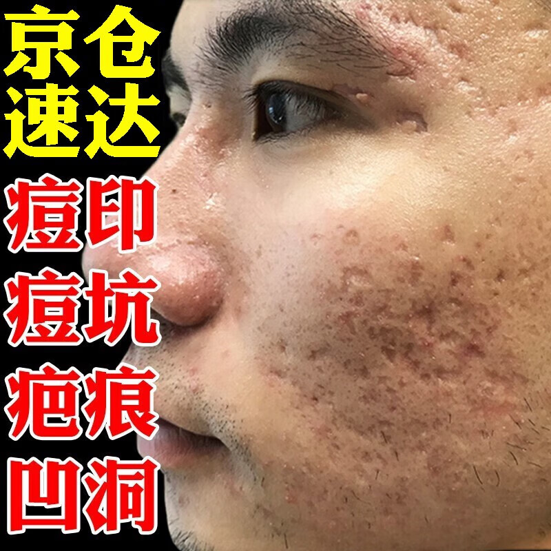 内廷上用祛痘印去痘坑去痘疤痘印痘坑修护复凹洞黑色素沉淀淡化 一盒