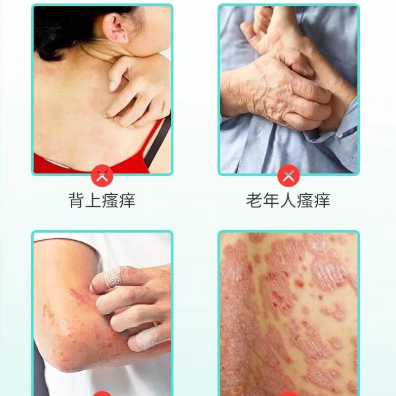 fujs【官方】佰草菊丁老年人皮肤痒瘙痒止痒膏老人全身红痒身上痒春夏