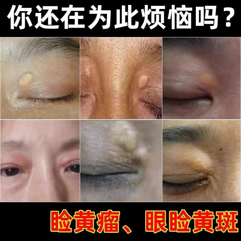 【旗舰优选】 眼睑黄瘤【睑黄瘤适用】睑黄疣脸黄瘤眼部眼睑黄瘤脂肪
