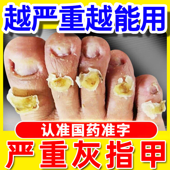 严重灰指甲专用药】指甲真菌感染脱甲厚甲空甲坏甲指甲发黄发绿反复