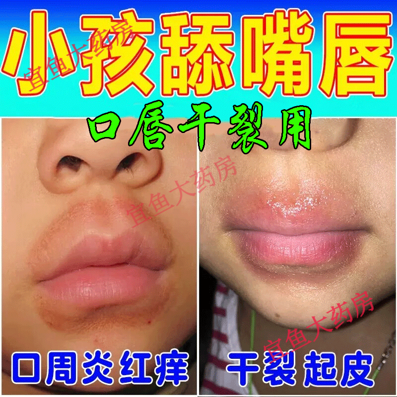 唇炎唇膏嘴角开裂嘴唇干裂脱皮嘴巴周围红肿瘙痒发黑男女儿童护唇裂