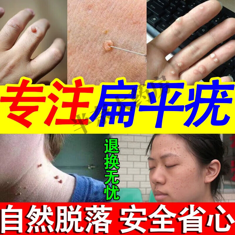 玫黛琳专用的水膏去i疣灵 肉粒颈部面部一抹灵刺瘊l