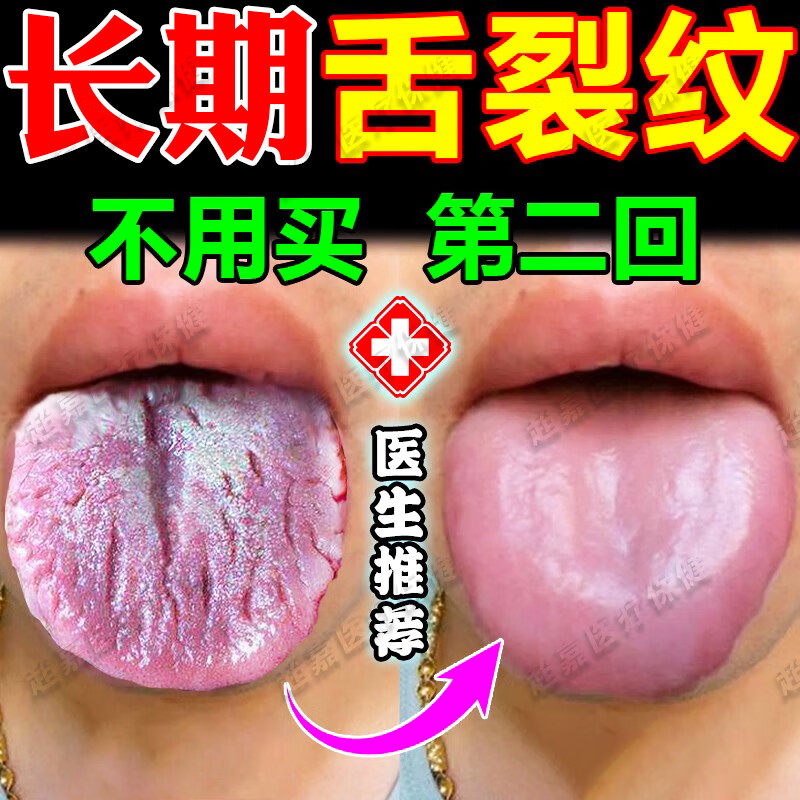 裂纹有齿痕舌苔白厚干裂舌炎舌头上火发热灼口综合证口腔麻木地图舌