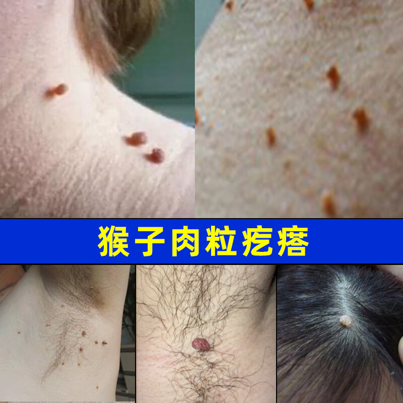 猴子去除脖子丝状尤颈部跖尤去除肉刺肉粒瘊子膏去尤湿尤鱼鳞痣克尤液